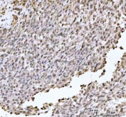 IHC staining of FFPE human testicular germ cell tumor tissue with DHX15 antibody. HIER: boil tissue sections in pH8 EDTA for 20 min and allow to cool before testing.
