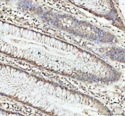 IHC staining of FFPE human colorectal adenocarcinoma tissue with DHX15 antibody. HIER: boil tissue sections in pH8 EDTA for 20 min and allow to cool before testing.