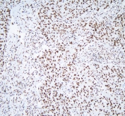 IHC staining of FFPE human lung cancer with AUF1 antibody. HIER: boil tissue sections in pH8 EDTA for 20 min and allow to cool before testing.