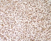 IHC staining of FFPE human renal cancer with AUF1 antibody. HIER: boil tissue sections in pH8 EDTA for 20 min and allow to cool before testing.
