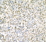 IHC staining of FFPE human B-lymphocytoma with AUF1 antibody. HIER: boil tissue sections in pH8 EDTA for 20 min and allow to cool before testing.