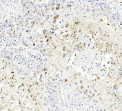 IHC staining of FFPE human esophagus squama cancer with MAFA antibody. HIER: boil tissue sections in pH8 EDTA for 20 min and allow to cool before testing.