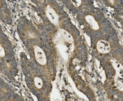 IHC staining of FFPE human rectal cancer with LRPPRC antibody. HIER: boil tissue sections in pH8 EDTA for 20 min and allow to cool before testing.