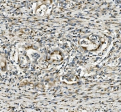 IHC staining of FFPE human rectal cancer with SGK1 antibody. HIER: boil tissue sections in pH8 EDTA for 20 min and allow to cool before testing.
