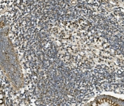 IHC staining of FFPE human rectal cancer with SGK1 antibody. HIER: boil tissue sections in pH8 EDTA for 20 min and allow to cool before testing.