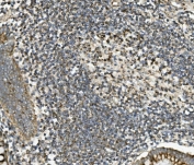 IHC staining of FFPE human rectal cancer with SGK1 antibody. HIER: boil tissue sections in pH8 EDTA for 20 min and allow to cool before testing.