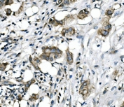 IHC staining of FFPE human breast cancer with RICTOR antibody. HIER: boil tissue sections in pH8 EDTA for 20 min and allow to cool before testing.