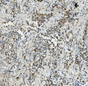 IHC staining of FFPE human lung cancer with TXN2 antibody. HIER: boil tissue sections in pH8 EDTA for 20 min and allow to cool before testing.