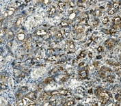 IHC staining of FFPE human stomach cancer with TXN2 antibody. HIER: boil tissue sections in pH8 EDTA for 20 min and allow to cool before testing.