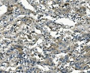 IHC staining of FFPE human liver cancer with AKR1D1 antibody. HIER: boil tissue sections in pH8 EDTA for 20 min and allow to cool before testing.
