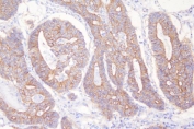 IHC staining of FFPE human rectal cancer with Desmoglein 2 antibody. HIER: boil tissue sections in pH8 EDTA for 20 min and allow to cool before testing.