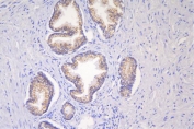 IHC staining of FFPE human prostate cancer with Desmoglein 2 antibody. HIER: boil tissue sections in pH8 EDTA for 20 min and allow to cool before testing.