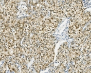 IHC staining of FFPE human liver cancer with PCK2 antibody. HIER: boil tissue sections in pH8 EDTA for 20 min and allow to cool before testing.