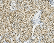 IHC staining of FFPE human liver cancer with PCK2 antibody. HIER: boil tissue sections in pH8 EDTA for 20 min and allow to cool before testing.
