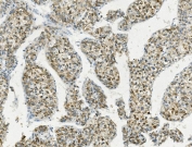 IHC staining of FFPE human liver cancer with PCK2 antibody. HIER: boil tissue sections in pH8 EDTA for 20 min and allow to cool before testing.