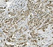 IHC staining of FFPE human breast cancer with PCK2 antibody. HIER: boil tissue sections in pH8 EDTA for 20 min and allow to cool before testing.