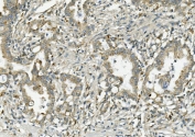 IHC staining of FFPE human rectal cancer with PCK2 antibody. HIER: boil tissue sections in pH8 EDTA for 20 min and allow to cool before testing.