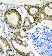 IHC staining of FFPE human rectal cancer with Neurofibromin antibody. HIER: boil tissue sections in pH8 EDTA for 20 min and allow to cool before testing.