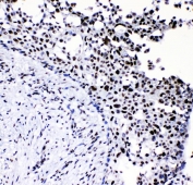 IHC staining of FFPE human breast cancer with Neurofibromin antibody. HIER: boil tissue sections in pH8 EDTA for 20 min and allow to cool before testing.