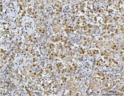 IHC staining of FFPE human seminoma testis tissue with Neurofibromin antibody. HIER: boil tissue sections in pH8 EDTA for 20 min and allow to cool before testing.