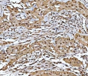 IHC staining of FFPE human bladder epithelial carcinoma tissue with Neurofibromin antibody. HIER: boil tissue sections in pH8 EDTA for 20 min and allow to cool before testing.