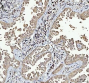 IHC staining of FFPE human lung cancer tissue with Menin antibody. HIER: boil tissue sections in pH8 EDTA for 20 min and allow to cool before testing.