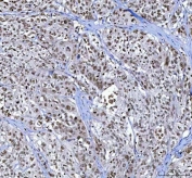 IHC staining of FFPE human bladder cancer tissue with Menin antibody. HIER: boil tissue sections in pH8 EDTA for 20 min and allow to cool before testing.