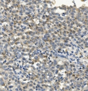 IHC staining of FFPE human liver cancer with CCR2 antibody. HIER: boil tissue sections in pH8 EDTA for 20 min and allow to cool before testing.