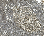 IHC staining of FFPE metastatic human rectal cancer in lymph node with HSPA8 antibody. HIER: boil tissue sections in pH8 EDTA for 20 min and allow to cool before testing.