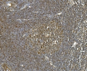 IHC staining of FFPE metastatic human rectal cancer in lymph node with HSPA8 antibody. HIER: boil tissue sections in pH8 EDTA for 20 min and allow to cool before testing.