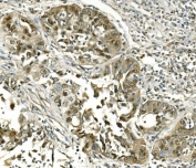 IHC staining of FFPE human lung cancer with HSPA8 antibody. HIER: boil tissue sections in pH8 EDTA for 20 min and allow to cool before testing.