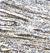 IHC staining of FFPE human rectal cancer with PTBP1 antibody. HIER: boil tissue sections in pH8 EDTA for 20 min and allow to cool before testing.
