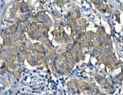 IHC staining of FFPE human breast cancer with RENT1 antibody. HIER: boil tissue sections in pH8 EDTA for 20 min and allow to cool before testing.