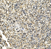 IHC staining of FFPE human testis cancer with HK1 antibody. HIER: boil tissue sections in pH8 EDTA for 20 min and allow to cool before testing.