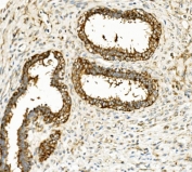 IHC staining of FFPE human breast cancer with HK1 antibody. HIER: boil tissue sections in pH8 EDTA for 20 min and allow to cool before testing.