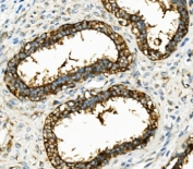 IHC staining of FFPE human breast cancer with HK1 antibody. HIER: boil tissue sections in pH8 EDTA for 20 min and allow to cool before testing.