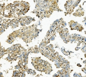 IHC staining of FFPE human lung cancer with HK1 antibody. HIER: boil tissue sections in pH8 EDTA for 20 min and allow to cool before testing.