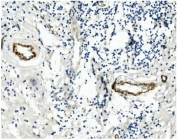 IHC staining of FFPE human breast cancer with MCAM antibody. HIER: boil tissue sections in pH8 EDTA for 20 min and allow to cool before testing.
