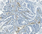 IHC staining of FFPE human rectal cancer with MCAM antibody. HIER: boil tissue sections in pH8 EDTA for 20 min and allow to cool before testing.