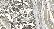 IHC staining of FFPE human bladder cancer with Folliculin antibody. HIER: boil tissue sections in pH8 EDTA for 20 min and allow to cool before testing.