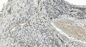 IHC staining of FFPE human rectal cancer with Folliculin antibody. HIER: boil tissue sections in pH8 EDTA for 20 min and allow to cool before testing.