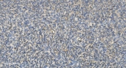 IHC staining of FFPE human skin cancer with Folliculin antibody. HIER: boil tissue sections in pH8 EDTA for 20 min and allow to cool before testing.