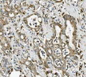 IHC staining of FFPE human rectal cancer with ME2 antibody. HIER: boil tissue sections in pH8 EDTA for 20 min and allow to cool before testing.