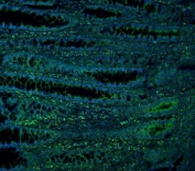 Immunofluorescent staining of FFPE human intestinal cancer with ME2 antibody (green) and DAPI nuclear stain (blue). HIER: steam section in pH6 citrate buffer for 20 min.
