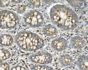 IHC staining of FFPE human rectal cancer with ME2 antibody. HIER: boil tissue sections in pH8 EDTA for 20 min and allow to cool before testing.