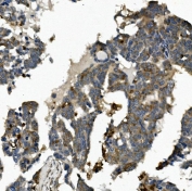 IHC staining of FFPE human ovarian cancer with ME2 antibody. HIER: boil tissue sections in pH8 EDTA for 20 min and allow to cool before testing.