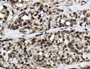 IHC staining of FFPE human pancreatic cancer with NFIC antibody. HIER: boil tissue sections in pH8 EDTA for 20 min and allow to cool before testing.