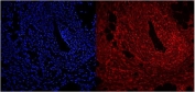 Immunofluorescent staining of FFPE human intestinal cancer with NFIC antibody (red) and DAPI nuclear stain (blue). HIER: steam section in pH6 citrate buffer for 20 min.