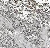 IHC staining of FFPE human testis cancer with LIN28A antibody. HIER: boil tissue sections in pH8 EDTA for 20 min and allow to cool before testing.