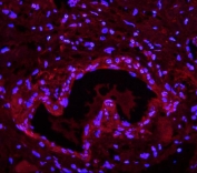 Immunofluorescent staining of FFPE human breast cancer with LIN28A antibody (red) and DAPI nuclear stain (blue). HIER: steam section in pH6 citrate buffer for 20 min.